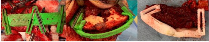 Cutting guides in use on the fibula, mandible and scapula