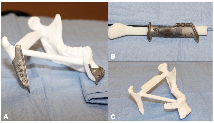 3D-printed mandible model with cutting guides and a fibula cutting guide