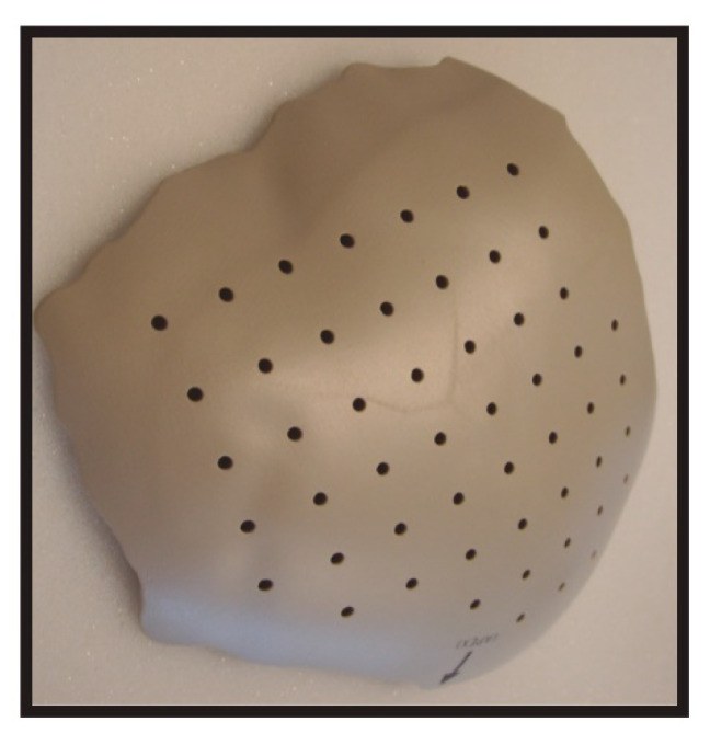 Patient-specific PEEK cranial implant