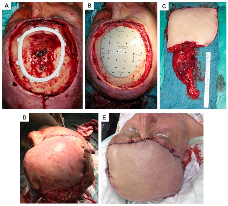 PEEK cranioplasty with free flap cover