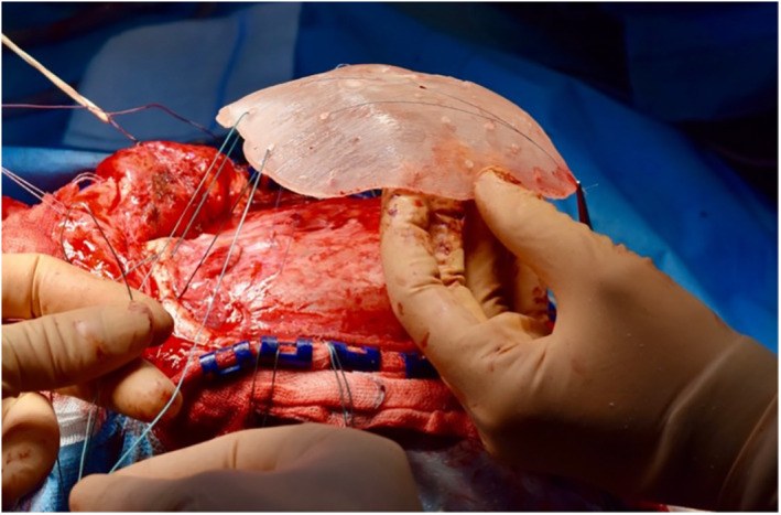 PMMA cranioplasty being placed on the skull defect