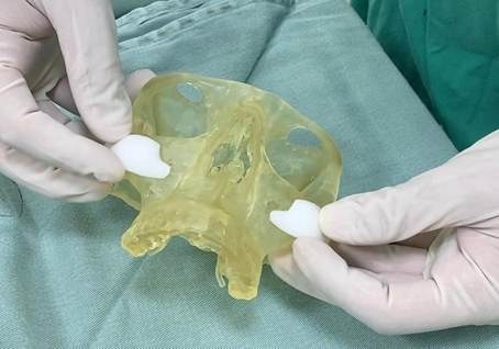Porous polyethylene implants adapted on a printed skull model