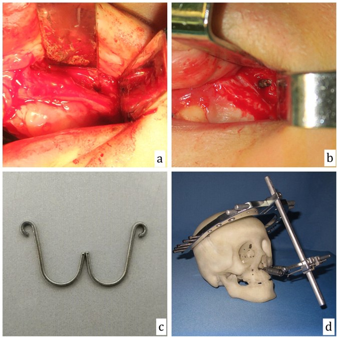 Rigid external distraction device on a skull model with traction hooks