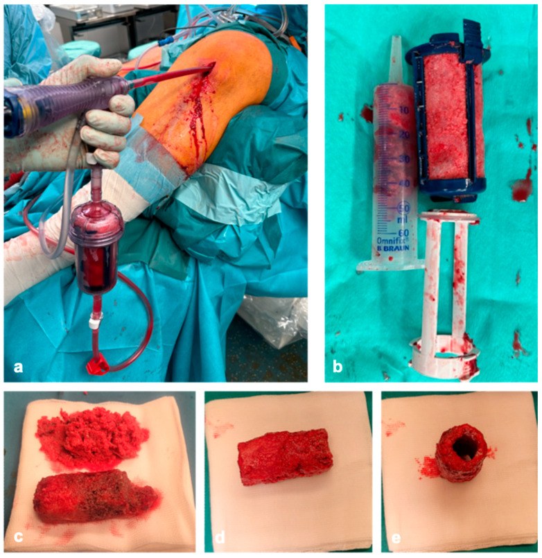 Reamer-irrigator-aspirator in use and the bone collected in its filter