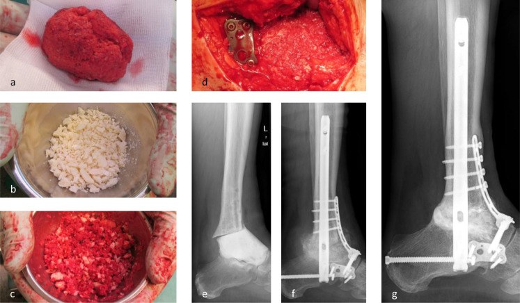 RIA autograft, freeze-dried allograft granules and the two mixed