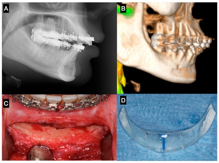 Bone resorption under a silicone chin implant