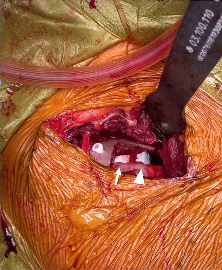 Beta-tricalcium phosphate block in an osteotomy gap