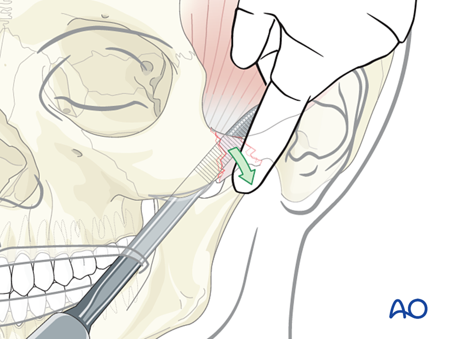 Intraoral (Keen) approach