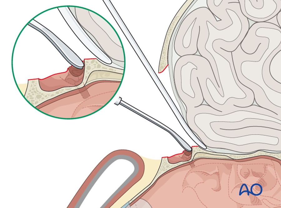 Closing the outflow tract
