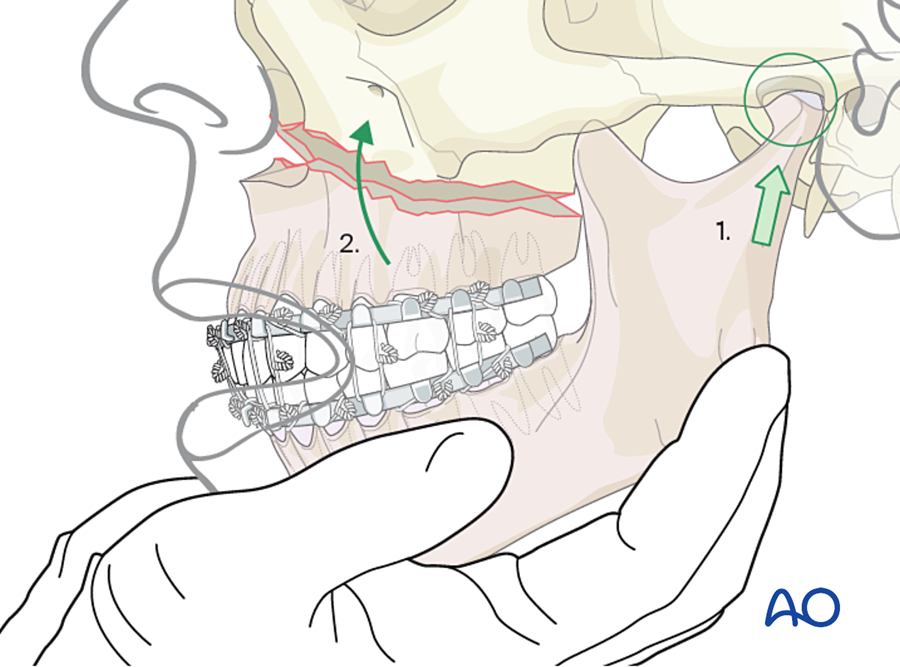 Steps 2 and 3: MMF, then rotate