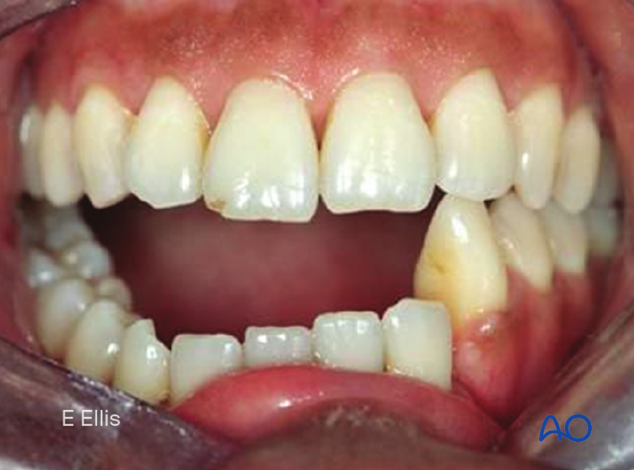 Malocclusion after a mandibular fracture