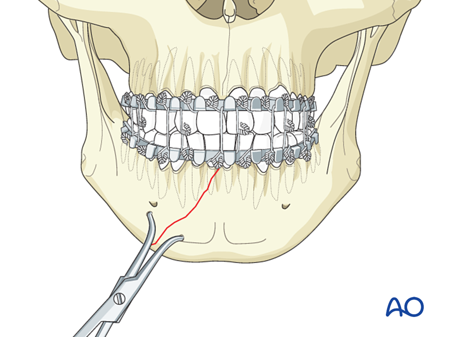 Reduction against the occlusion