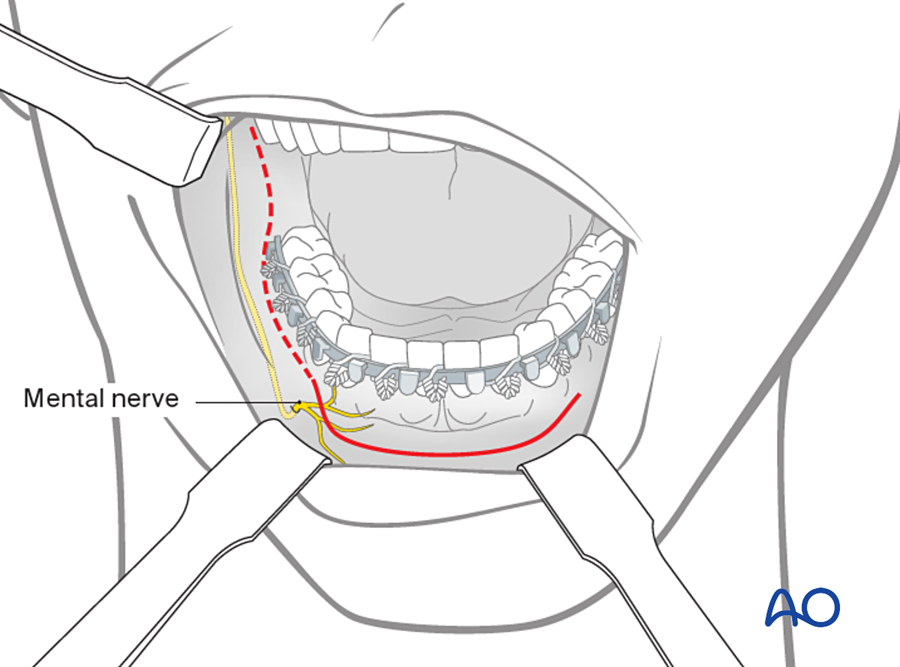 Incision through the mouth