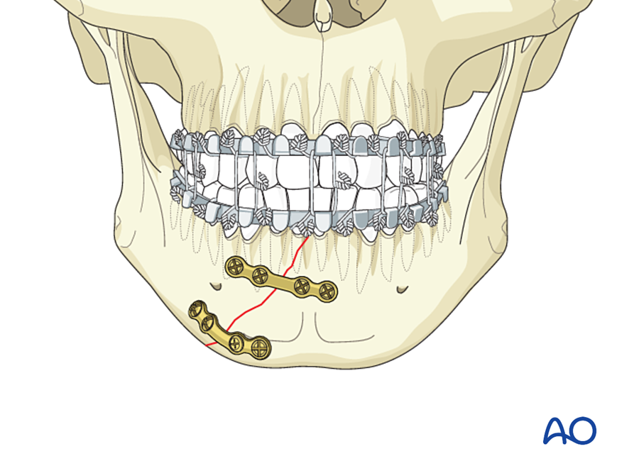 Two plates at the symphysis