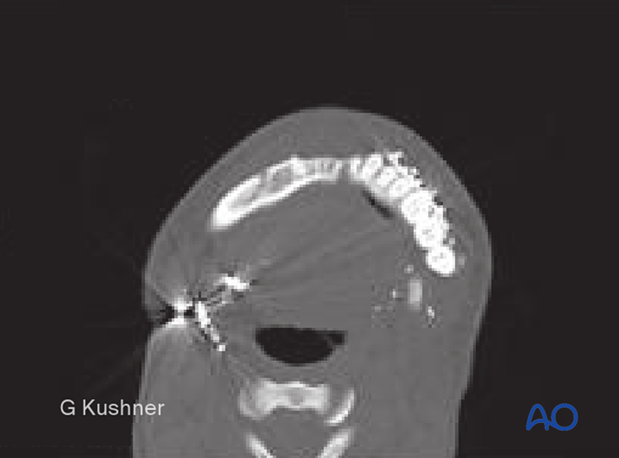 Widened mandible on CT