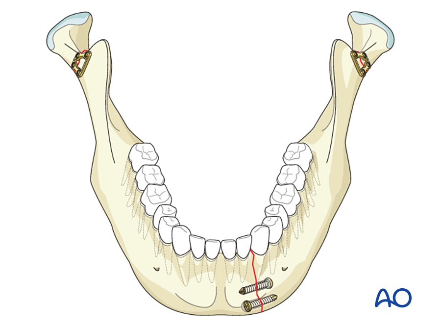 Symphysis and both condyles fixed