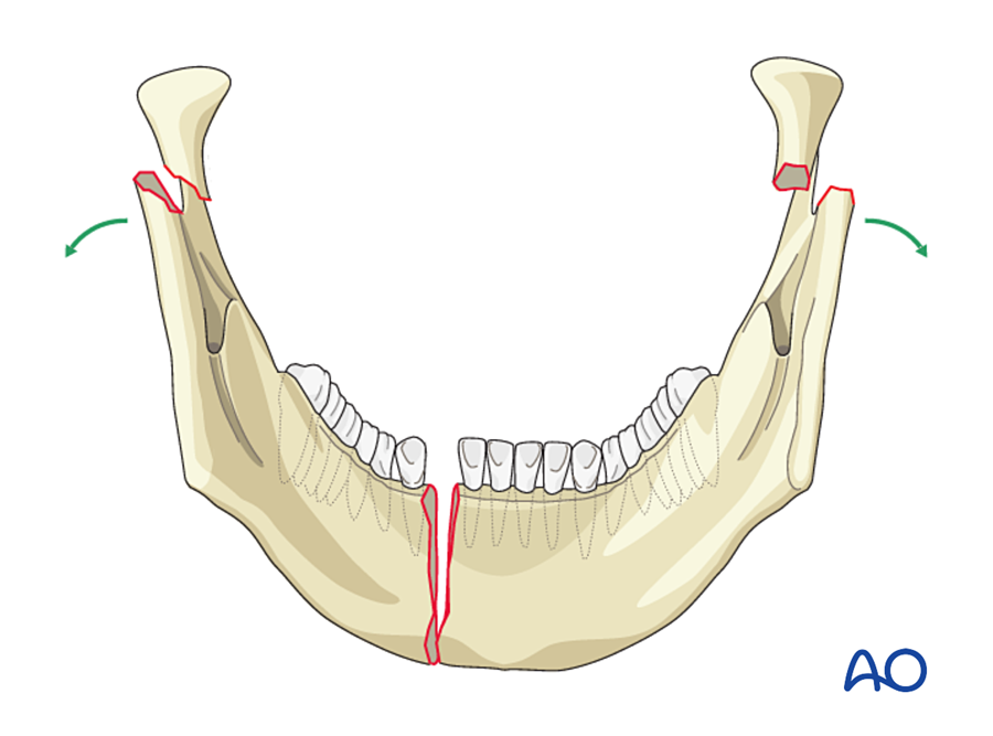 Why the mandible widens