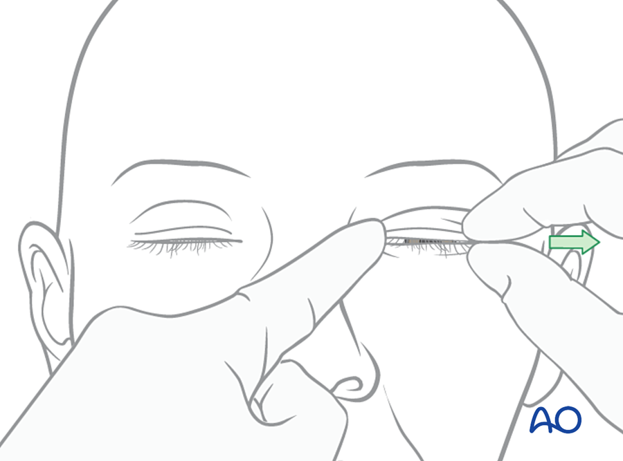 Bow-string test