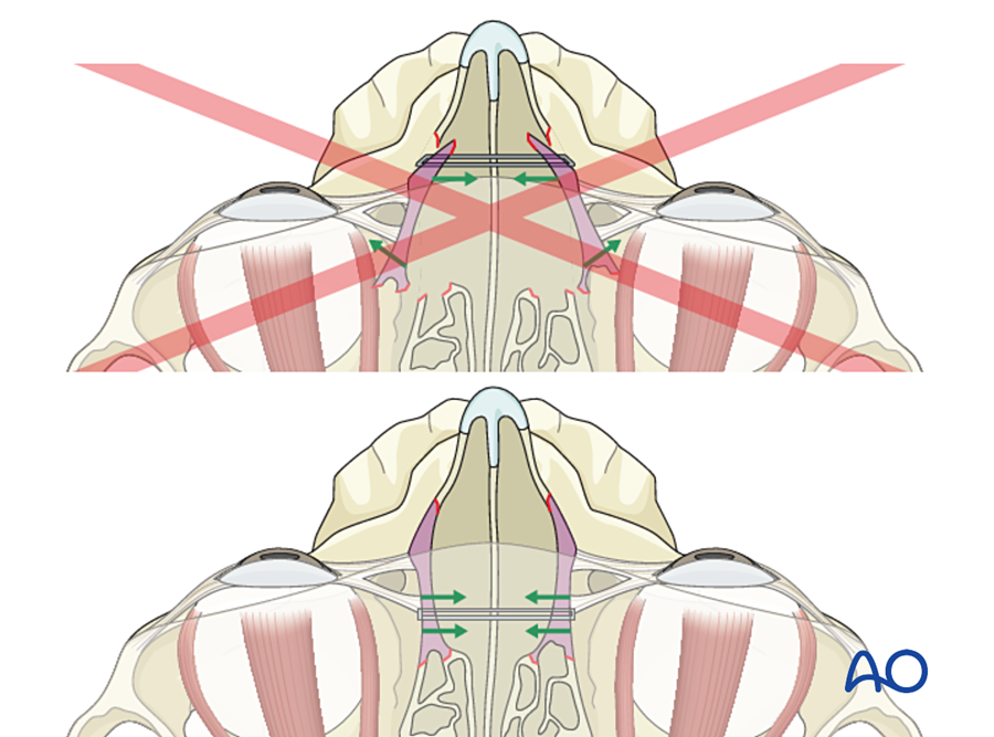 Position of the transnasal wire