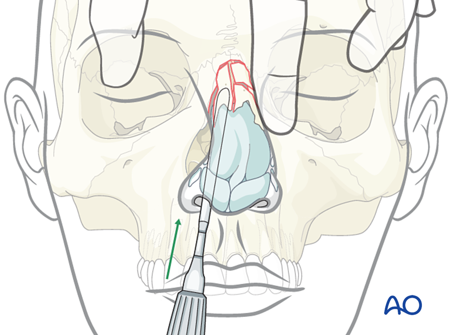 Elevating the nasal bone