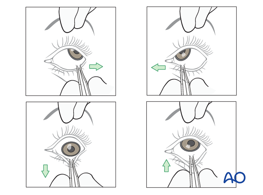 Forced duction test