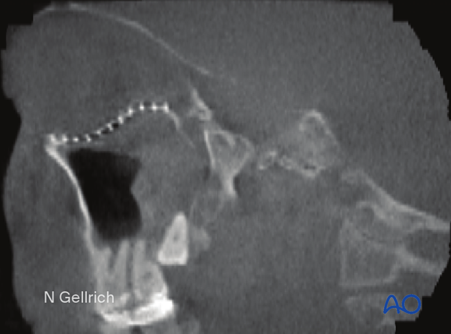 Shape of the floor on sagittal CT
