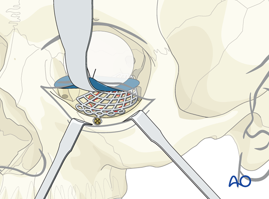 Implant in place