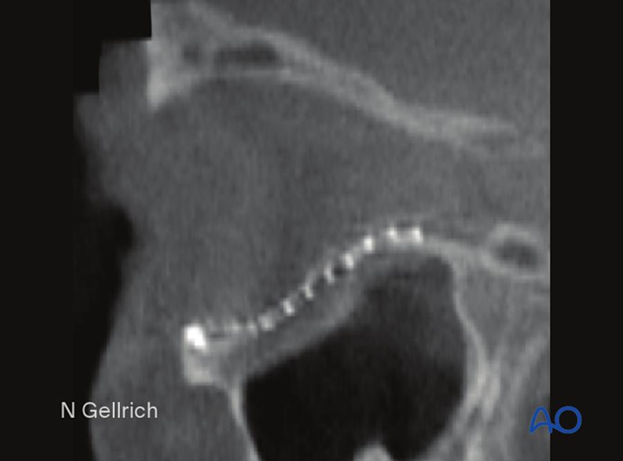 Result on CT
