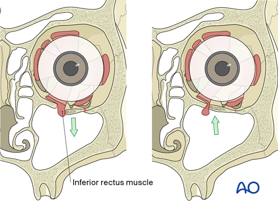 Trapdoor fracture in a child