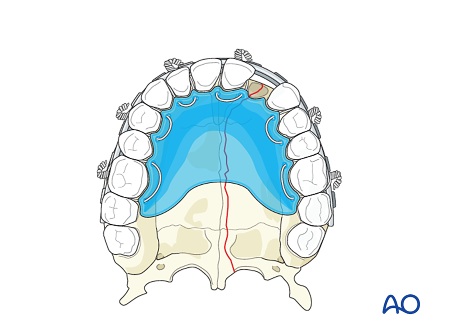 Step 2: restore the dental arch