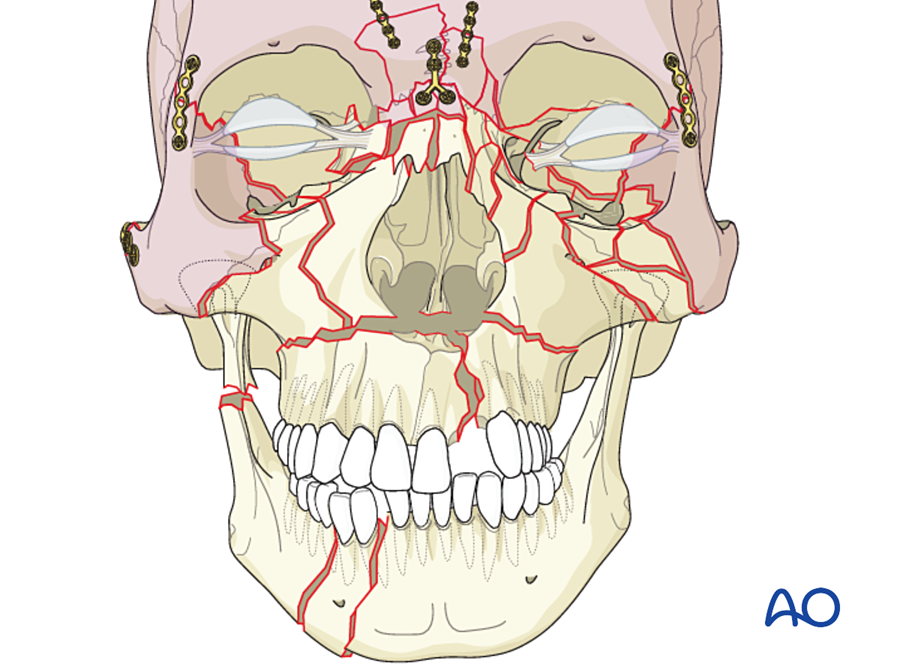 Steps 4 to 6: the upper face