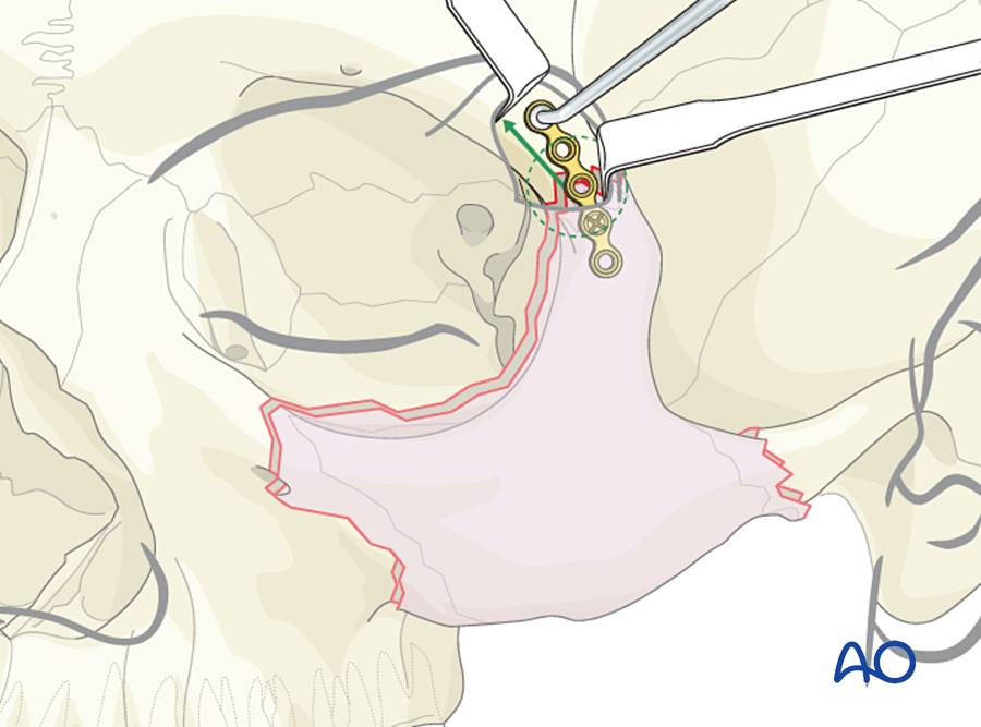 First plate at the zygomaticofrontal suture