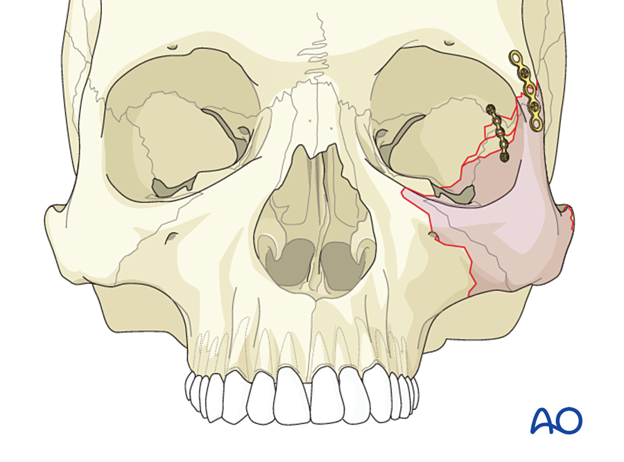 The lateral orbital wall