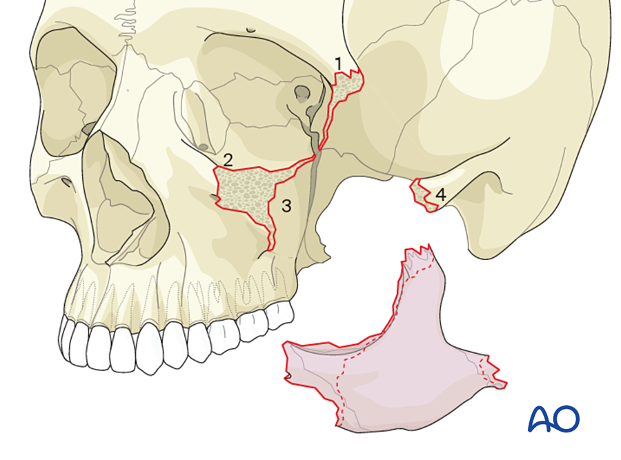 Fracture lines of the zygoma