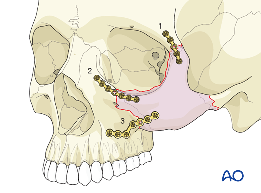 Order of plates in three-point fixation