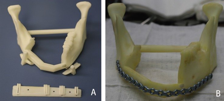 Pre-bent reconstruction plate on a printed model