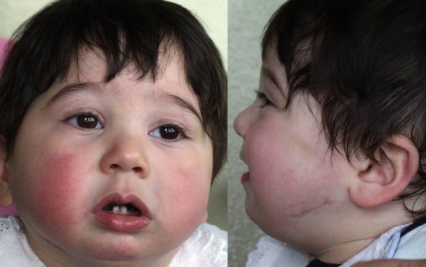 Infant after mandibular distraction