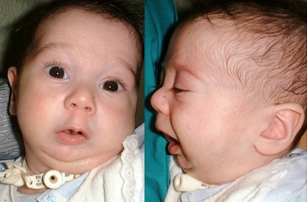 Infant with micrognathia before distraction