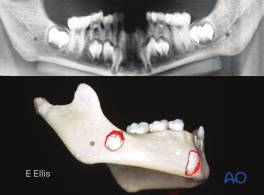 Tooth germs in the growing mandible