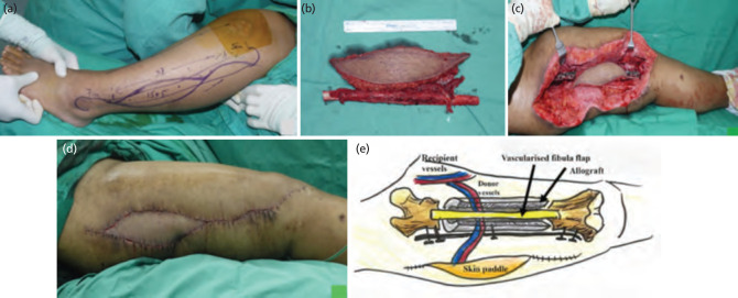 Fibula flap with massive allograft for a femoral defect