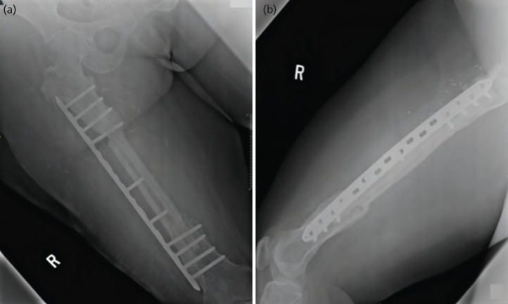 X-ray two years after reconstruction