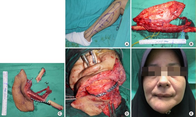 USM free fibula mandibular reconstruction