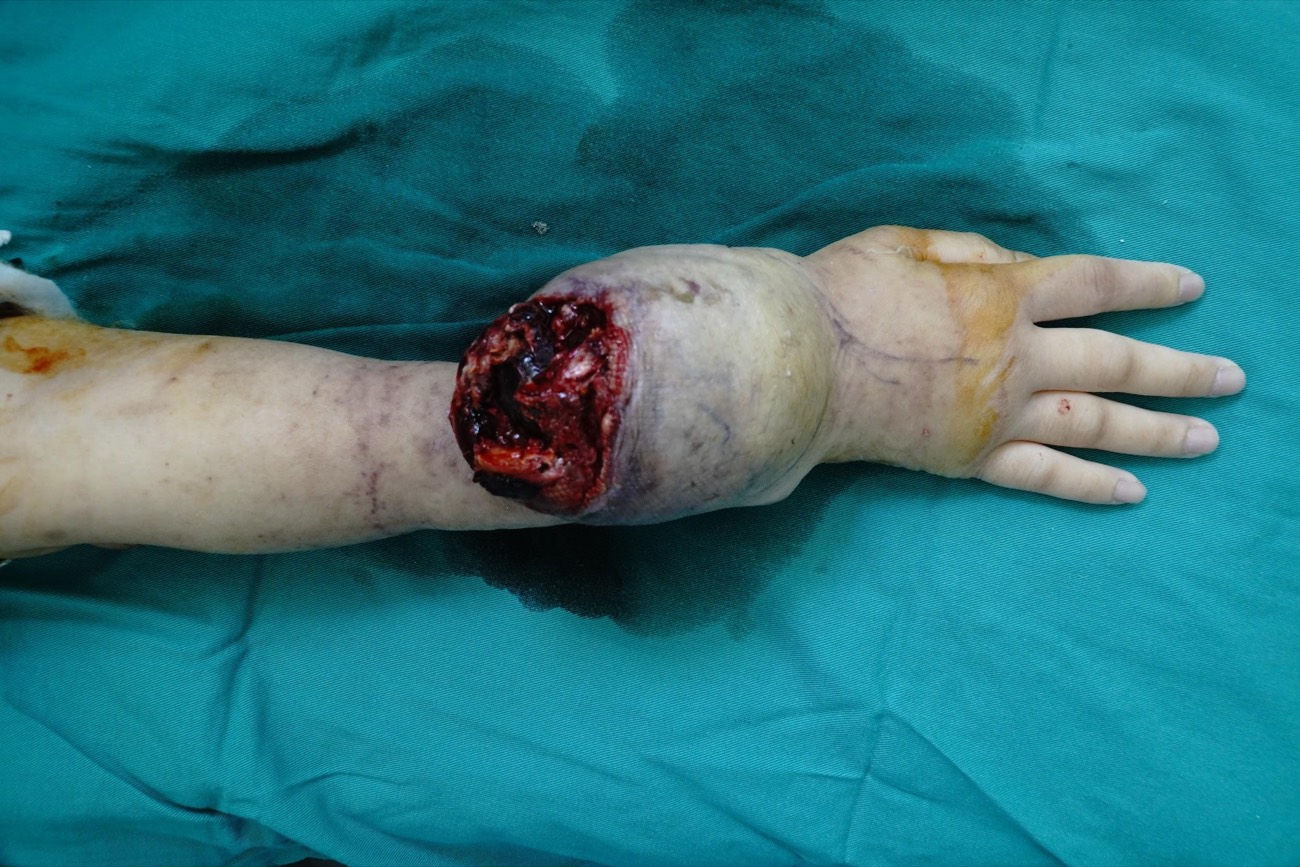 Tumor of the distal radius