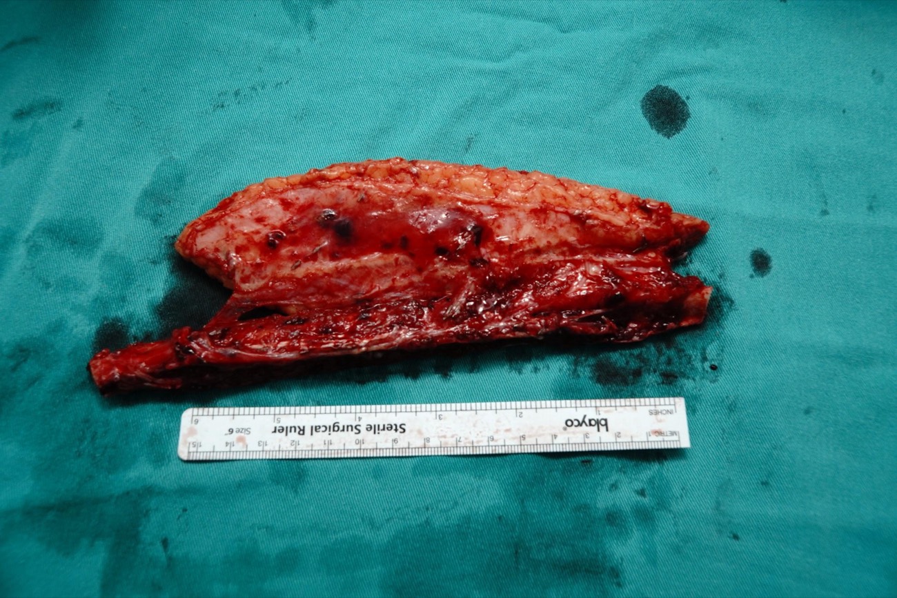 Resected specimen