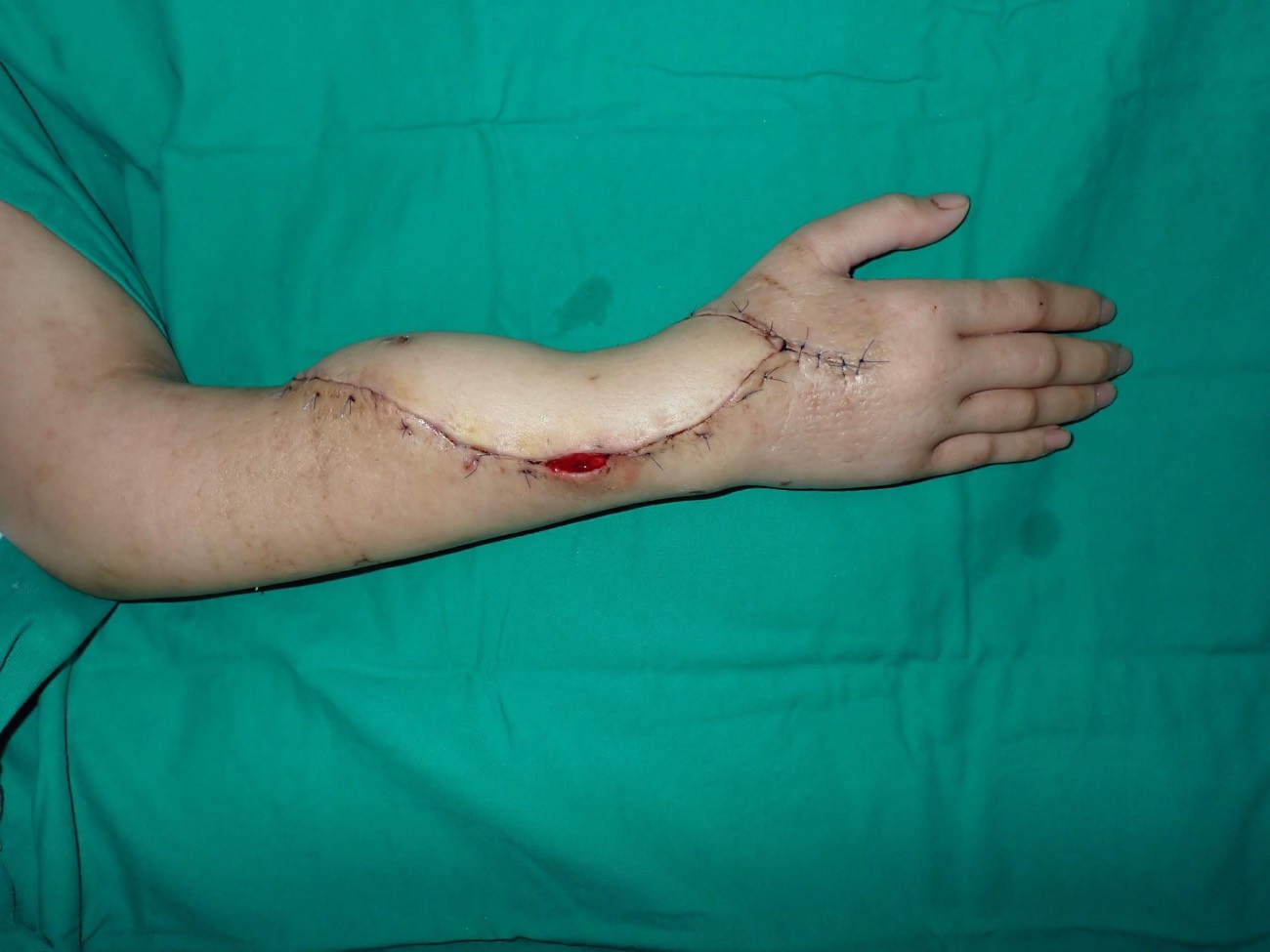 Forearm after reconstruction